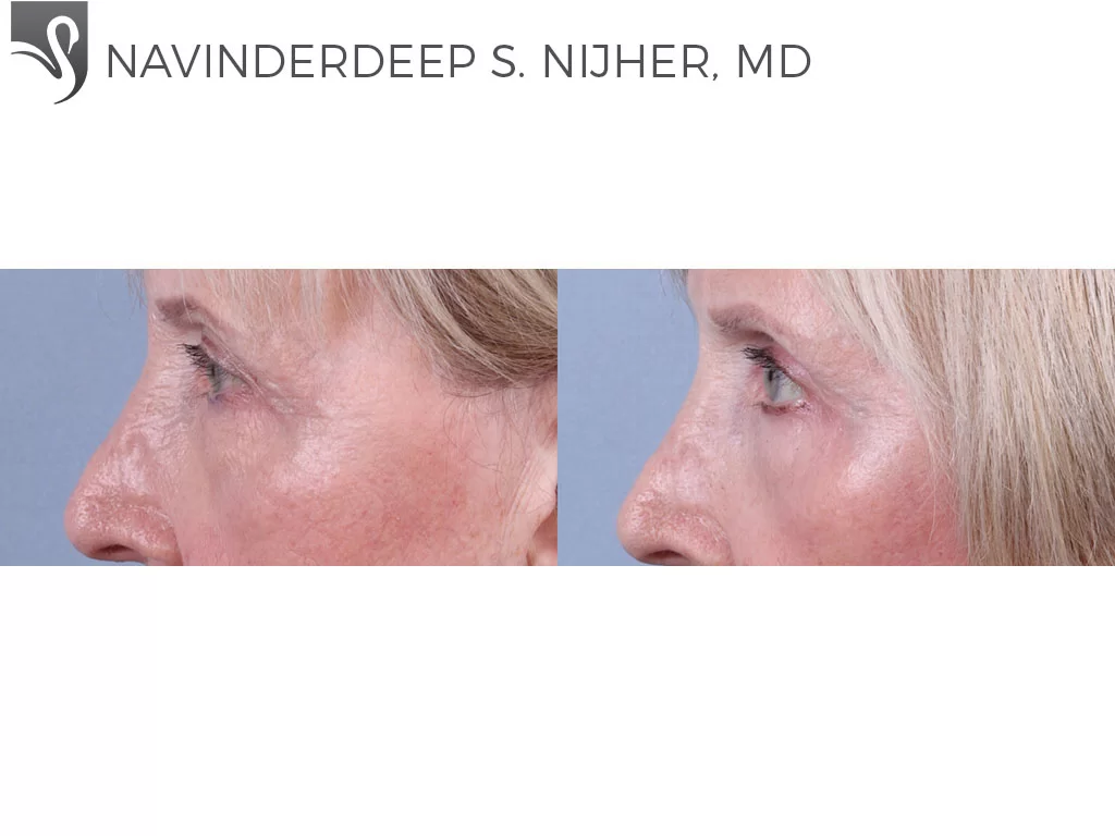 Before and After Image: Eyelid Surgery Case #72454 - left-side