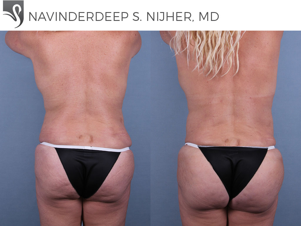 Before and After Image: Brazilian Butt Lift Case #72696