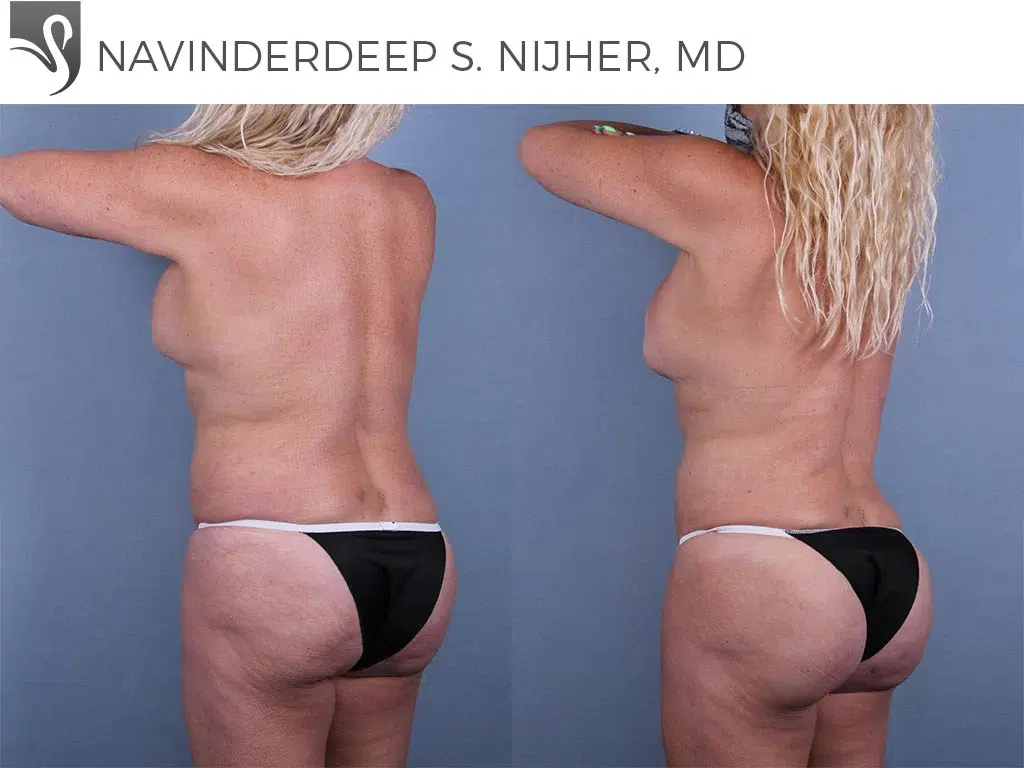 Before and After Image: Brazilian Butt Lift Case #72696 - left-back-oblique
