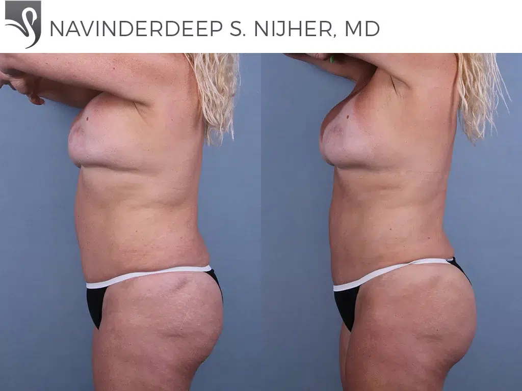 Before and After Image: Brazilian Butt Lift Case #72696 - left-side