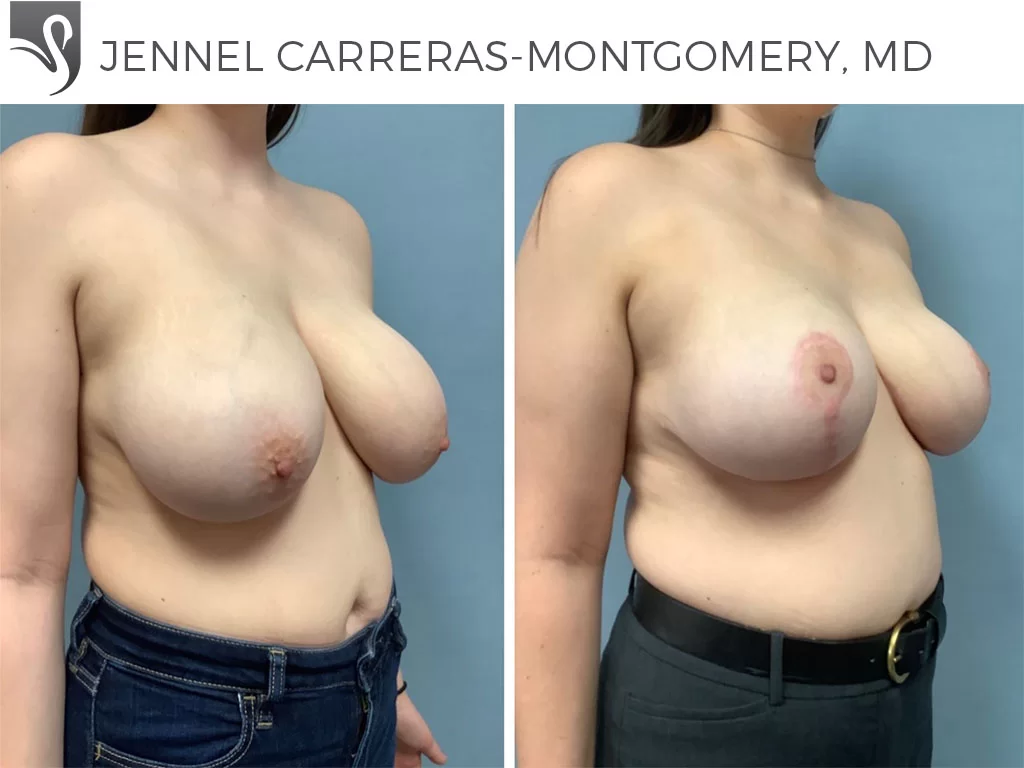 Before and After Image: Female Breast Reduction Case #72709 - right-front-oblique