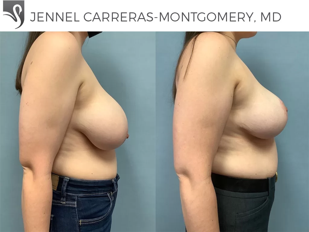 Before and After Image: Female Breast Reduction Case #72709 - right-side