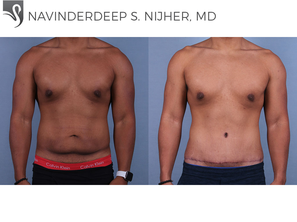 Before and After Image: Abdominoplasty (Tummy Tuck) Case #72744 - front