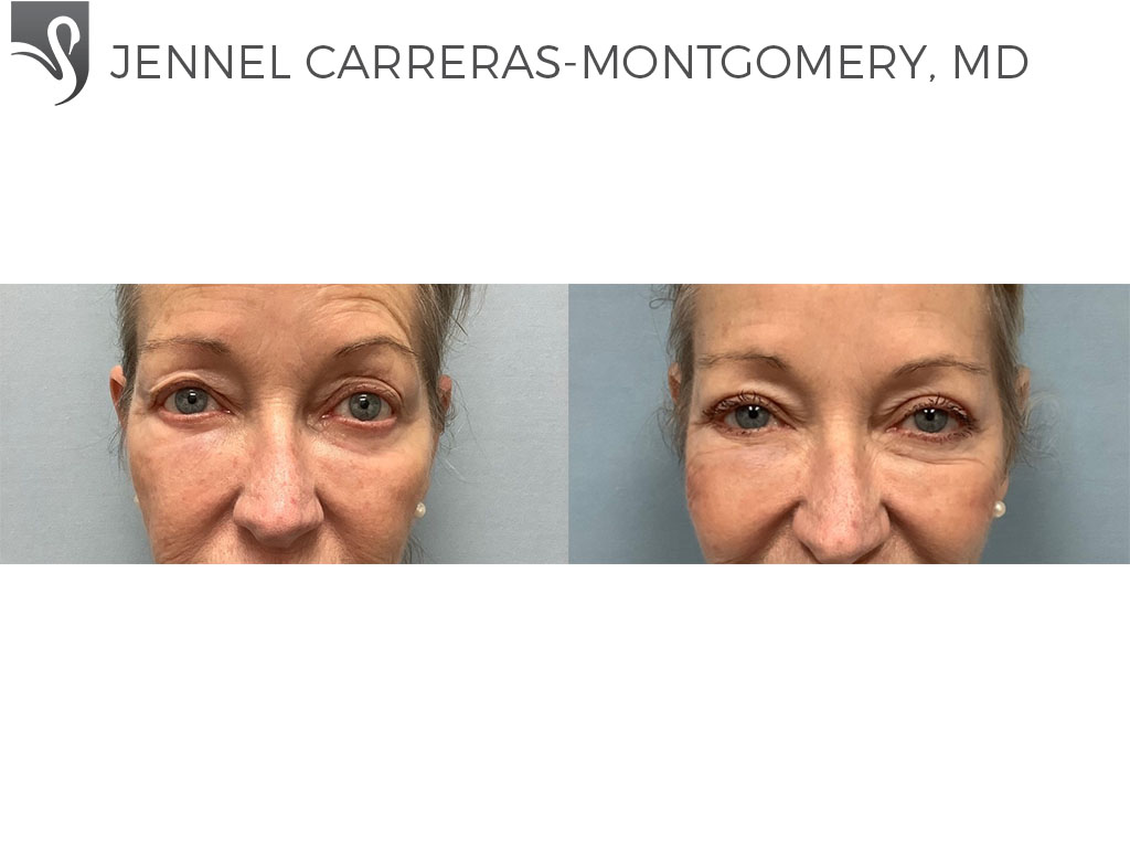 Before and After Image: Eyelid Surgery Case #72900 - front