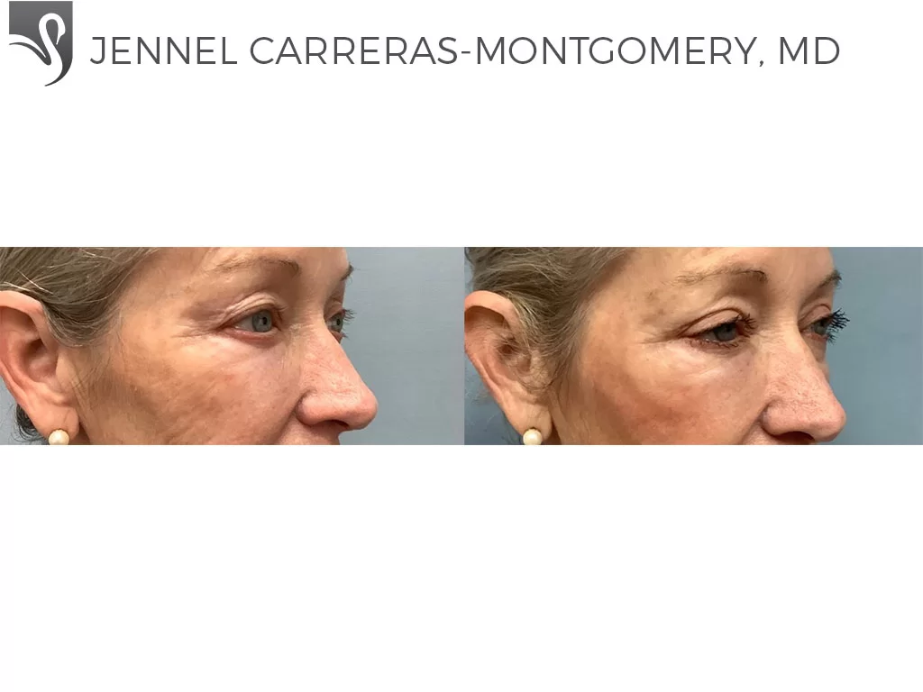 Before and After Image: Eyelid Surgery Case #72900 - right-front-oblique