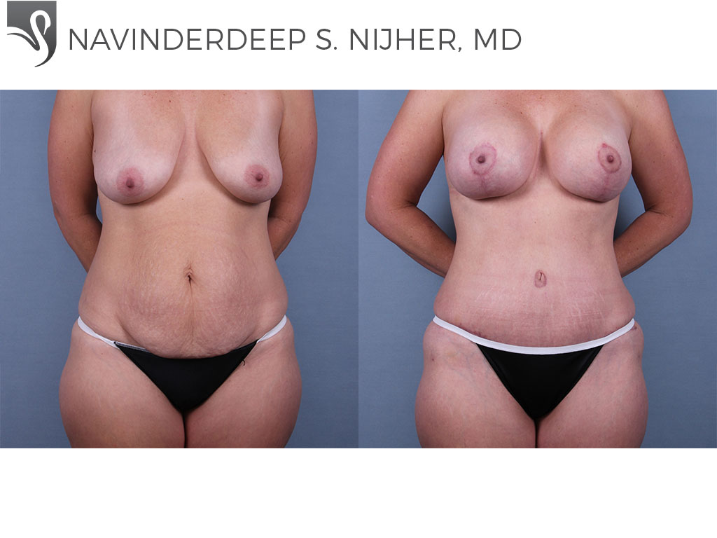 Before and After Image: Abdominoplasty (Tummy Tuck) Case #72926 - front