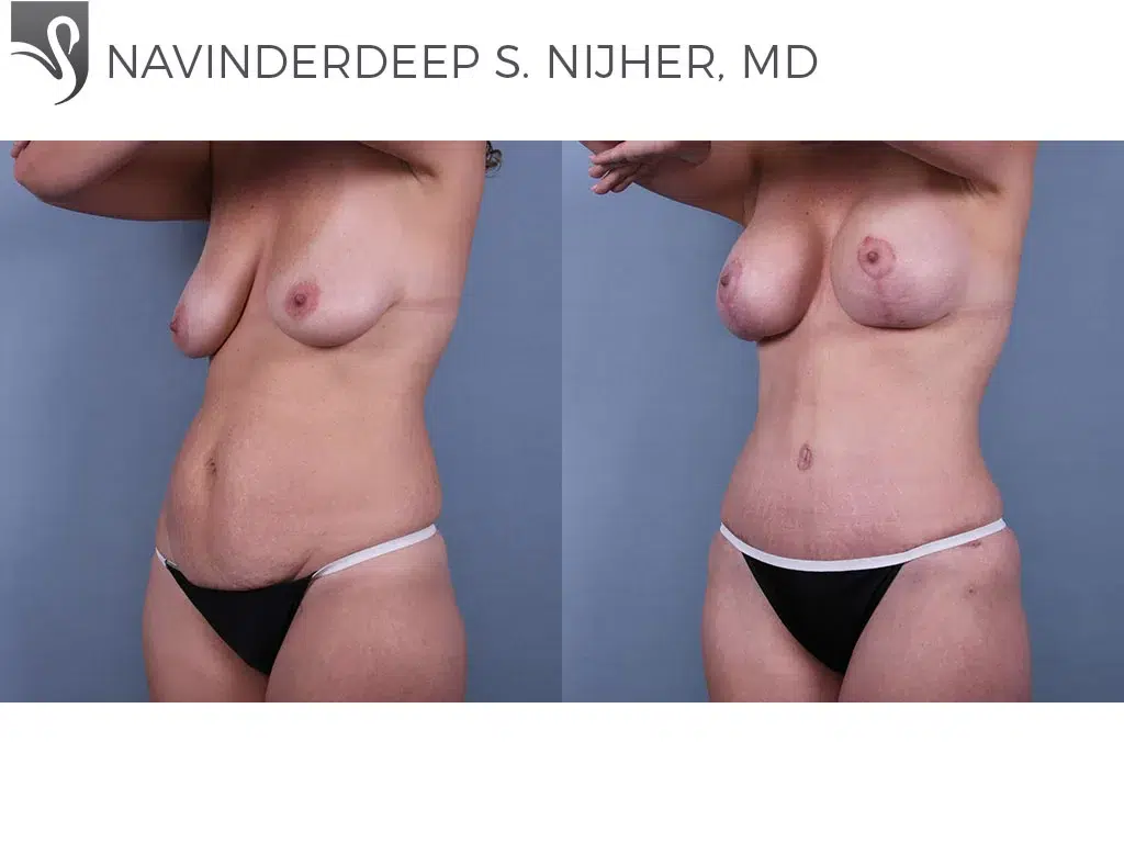 Before and After Image: Abdominoplasty (Tummy Tuck) Case #72926 - left-front-oblique