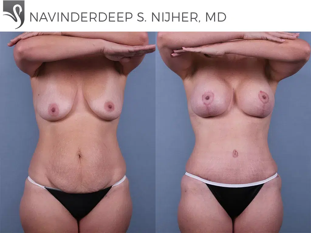 Before and After Image: Mommy Makeover Case #72926 - front