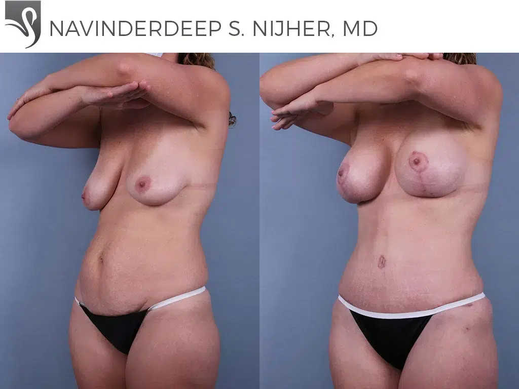 Before and After Image: Mommy Makeover Case #72926 - left-front-oblique