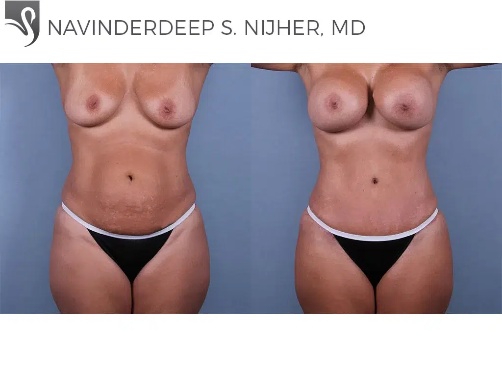 Before and After Image: Abdominoplasty (Tummy Tuck) Case #72961 - front