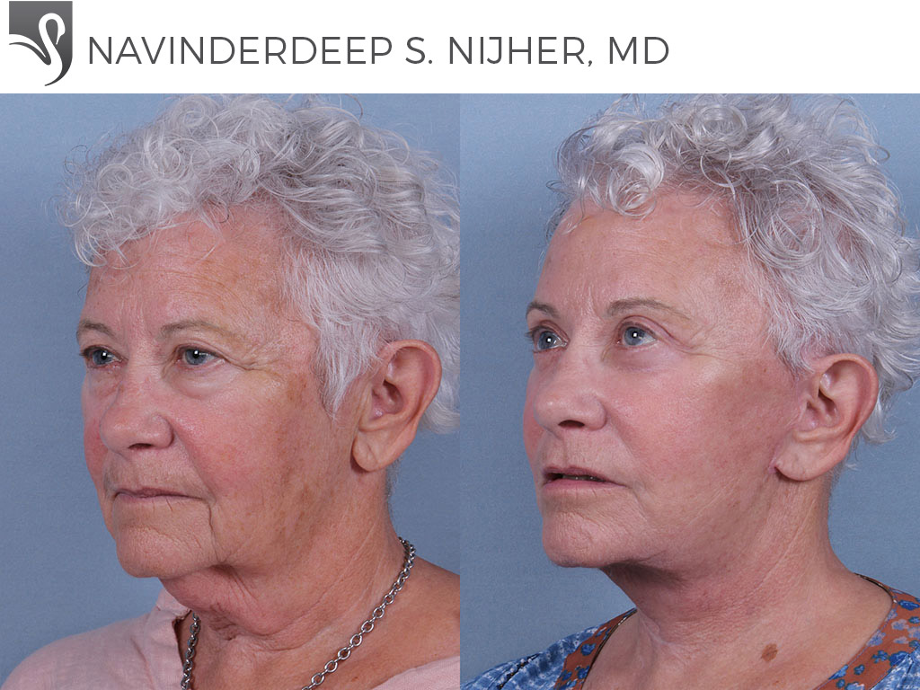 Before and After Image: Eyelid Surgery Case #73111