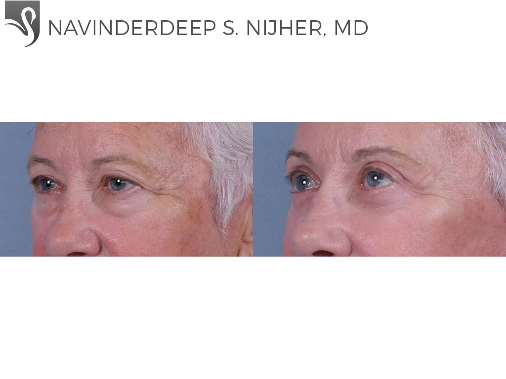 Before and After Image: Eyelid Surgery Case #73111 - left-front-oblique