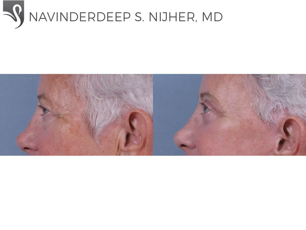 Before and After Image: Eyelid Surgery Case #73111 - left-side