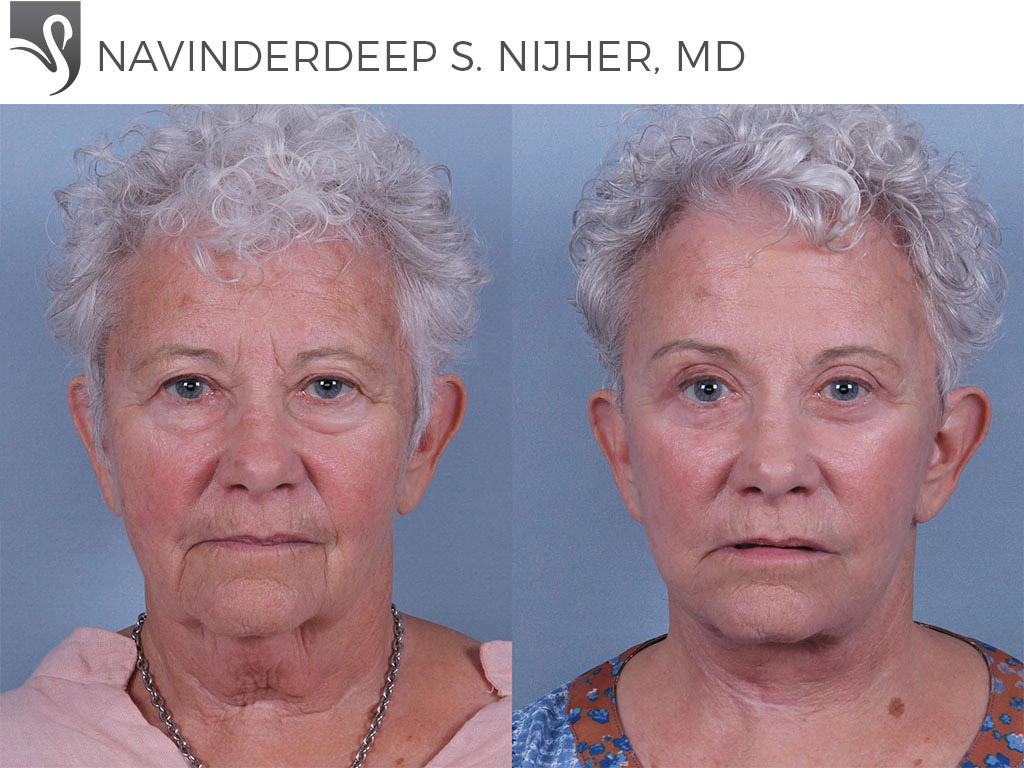 Before and After Image: Face Lift Case #73111 - front