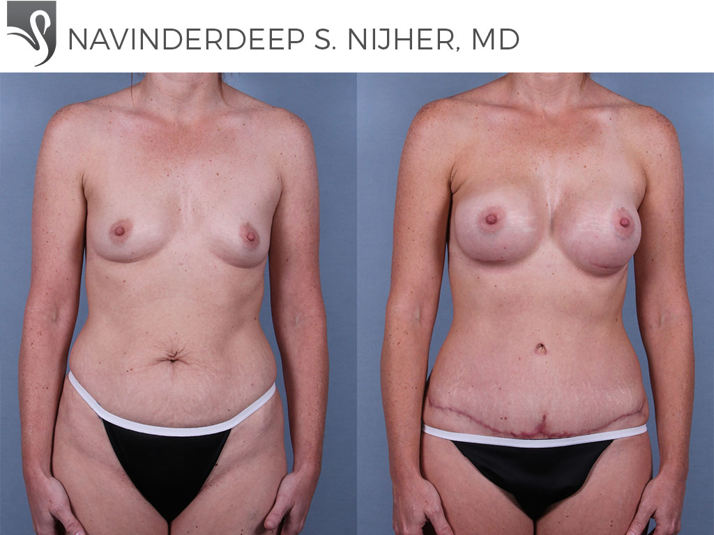 Before and After Image: Mommy Makeover Case #73493 - front