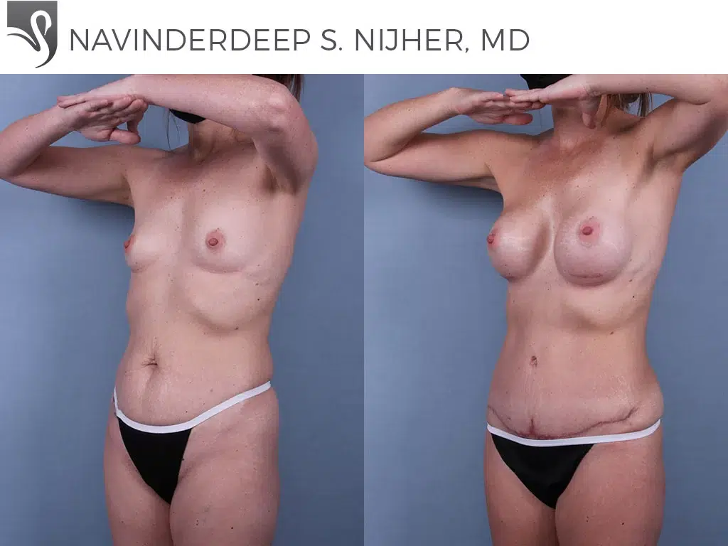 Before and After Image: Mommy Makeover Case #73493 - left-front-oblique