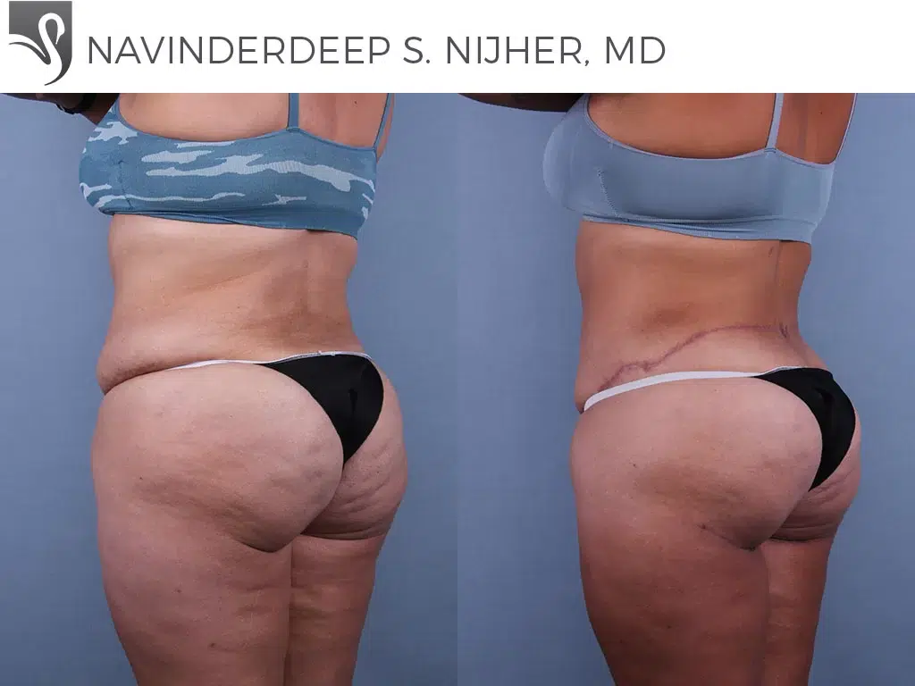 Before and After Image: Body Contouring Case #73583 - left-back-oblique