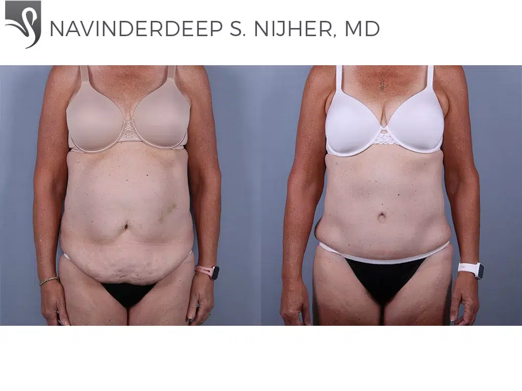 Before and After Image: Abdominoplasty (Tummy Tuck) Case #73591 - front