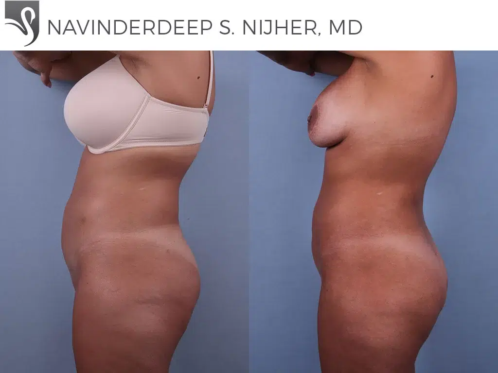 Before and After Image: Brazilian Butt Lift Case #73806 - left-side