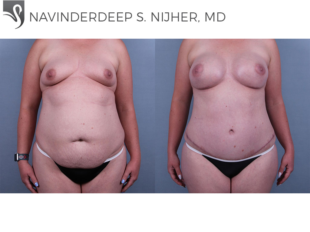 Before and After Image: Abdominoplasty (Tummy Tuck) Case #73914 - front