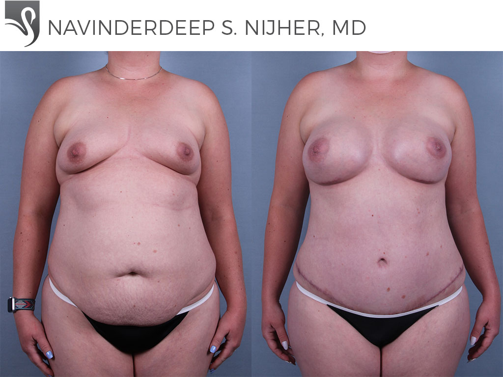 Before and After Image: Mommy Makeover Case #73914 - front