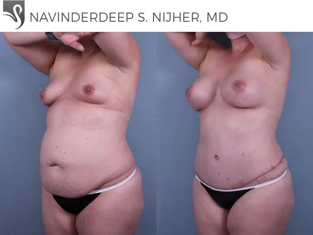 Before and After Image: Mommy Makeover Case #73914 - left-front-oblique