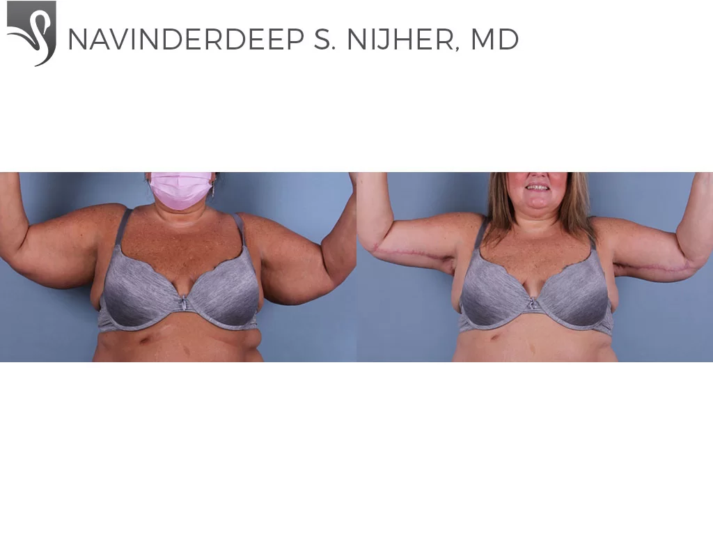 Before and After Image: Arm Lift Case #73943