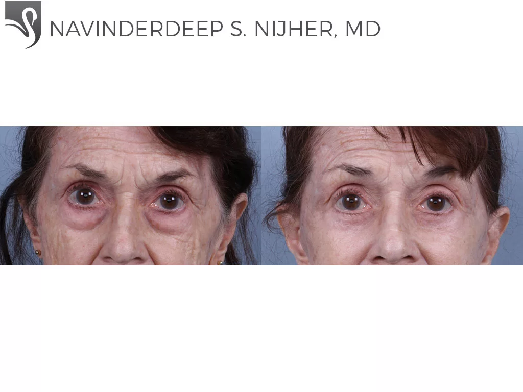 Before and After Image: Eyelid Surgery Case #73993