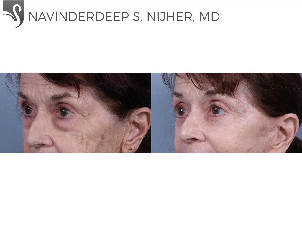 Before and After Image: Eyelid Surgery Case #73993 - left-front-oblique