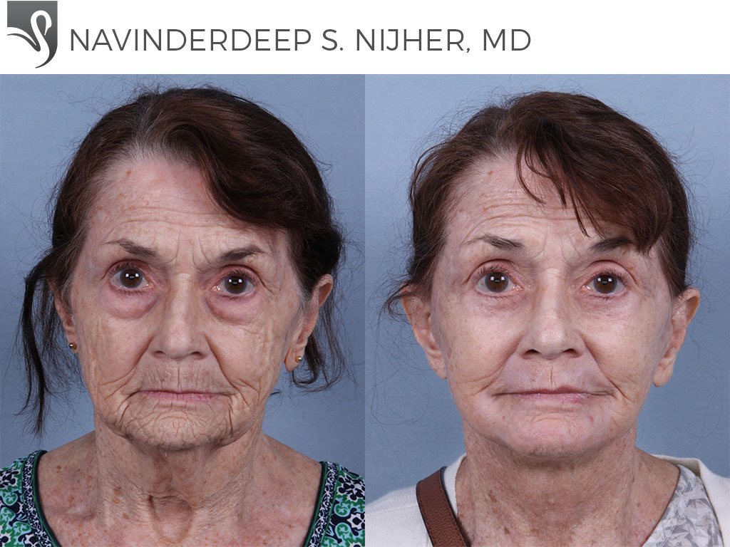 Before and After Image: Face Lift Case #73993 - front