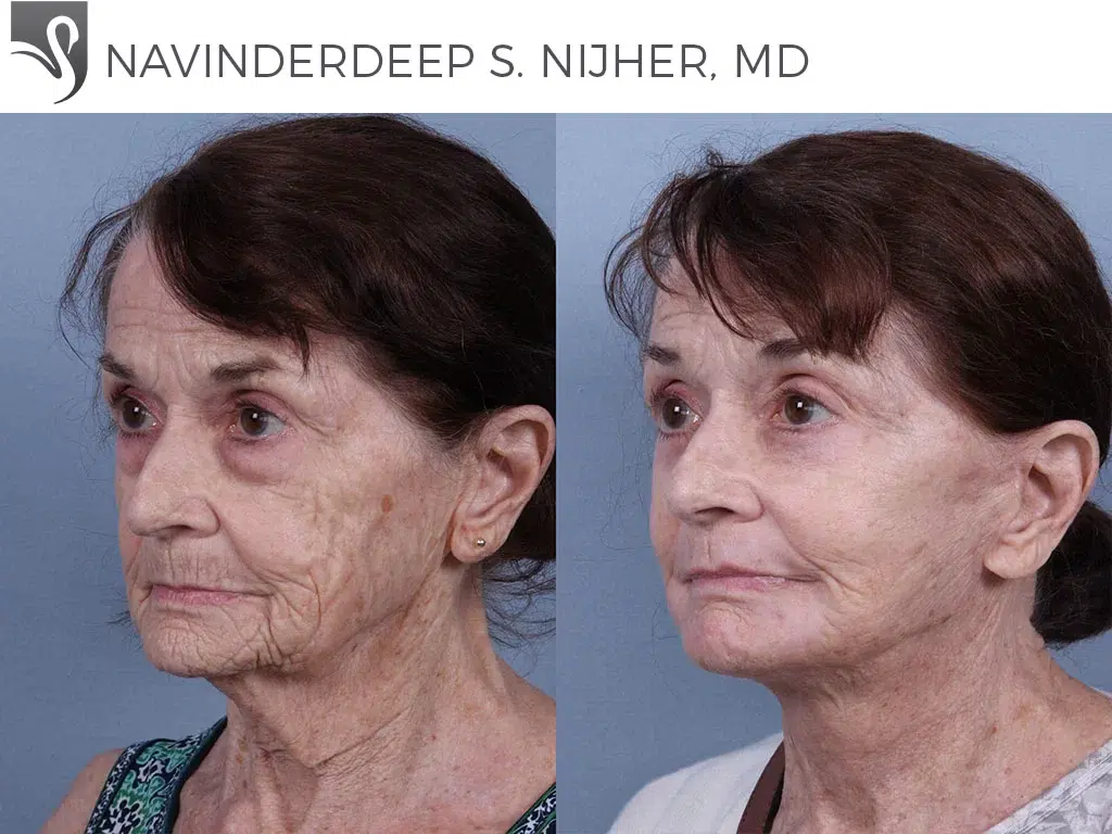Before and After Image: Face Lift Case #73993 - left-front-oblique