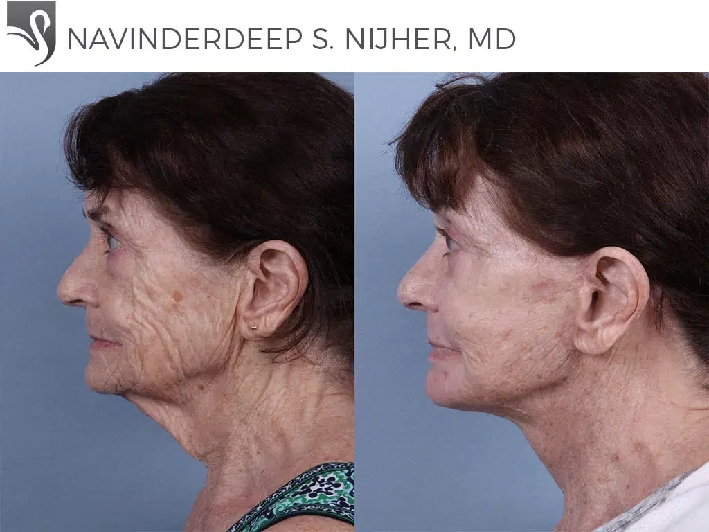 Before and After Image: Face Lift Case #73993 - left-side