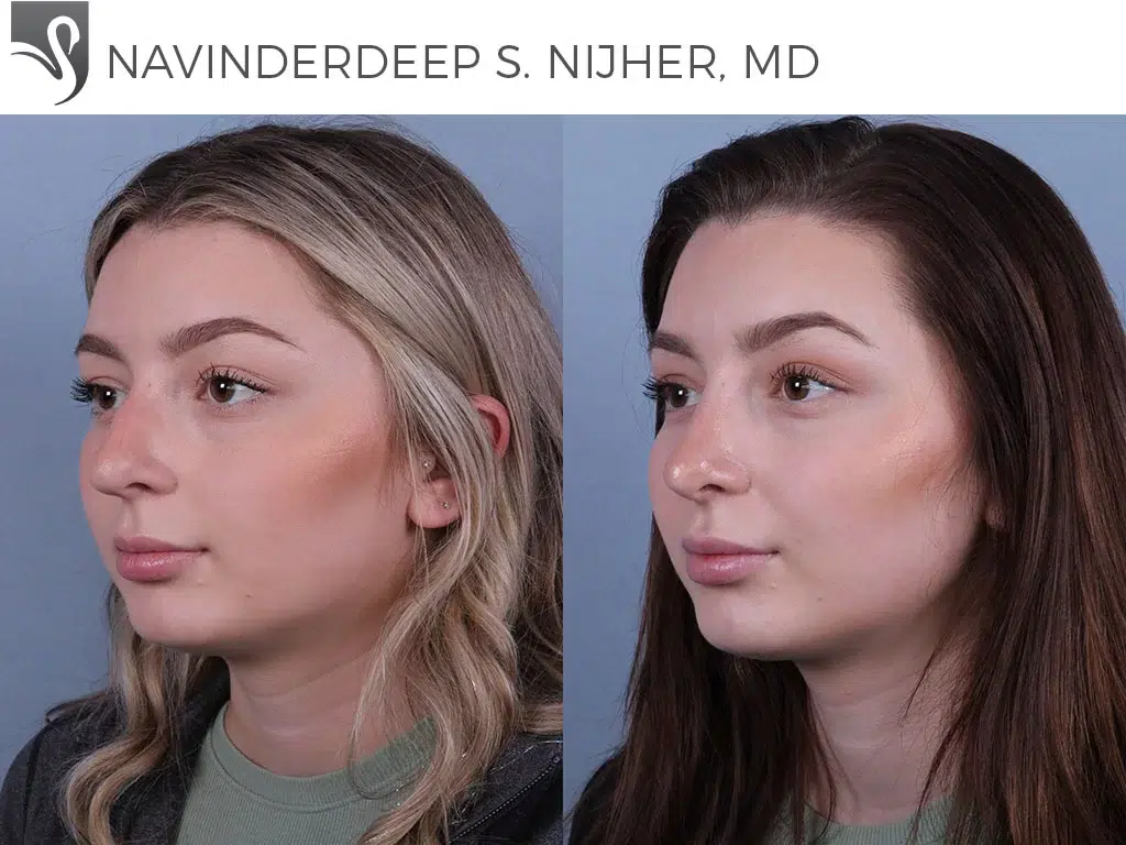 Before and After Image: Rhinoplasty Case #74109 - left-front-oblique