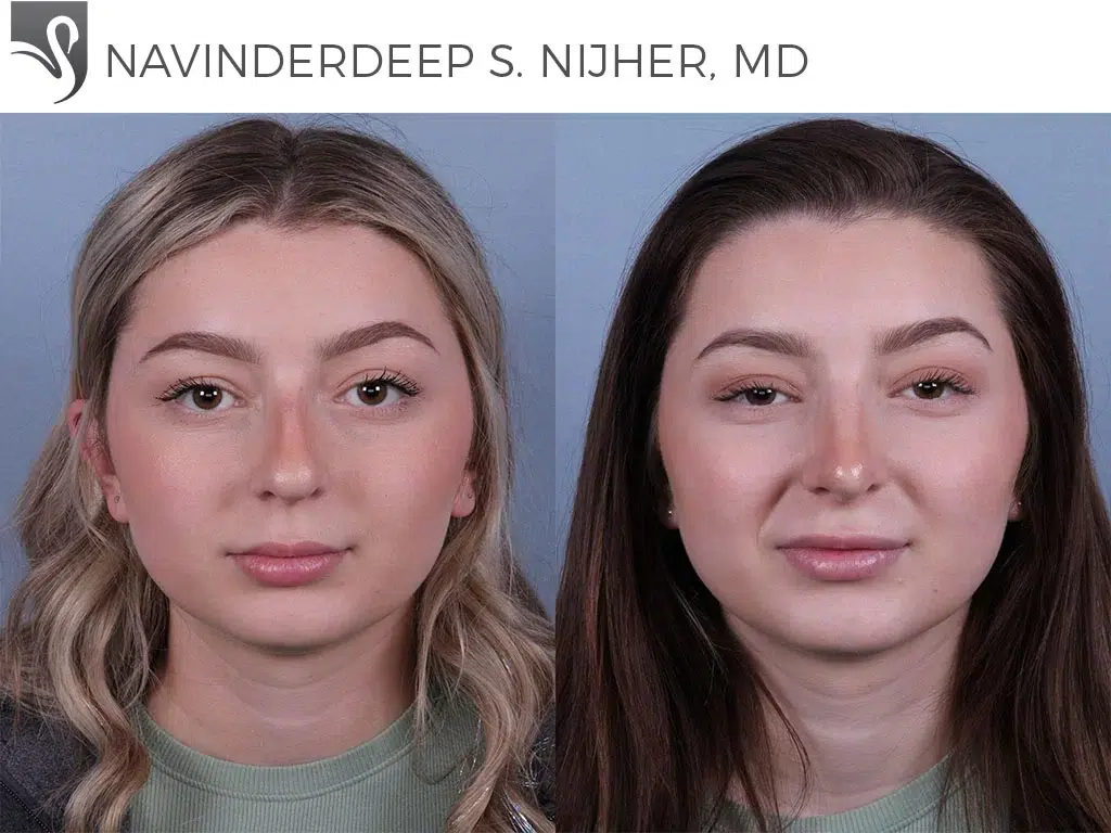 Before and After Image: Rhinoplasty Case #74109 - front
