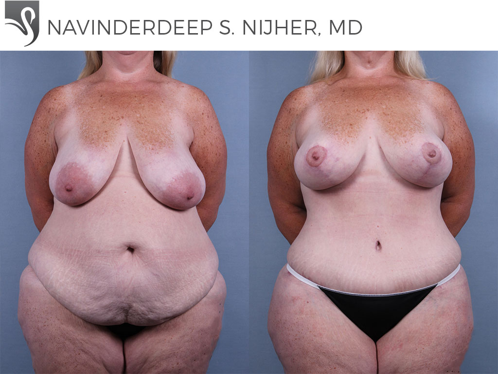 Before and After Image: Mommy Makeover Case #74132 - front