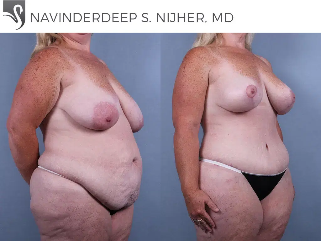 Before and After Image: Mommy Makeover Case #74132 - right-front-oblique