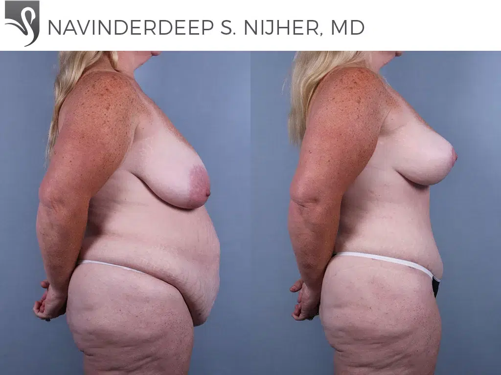 Before and After Image: Mommy Makeover Case #74132 - right-side