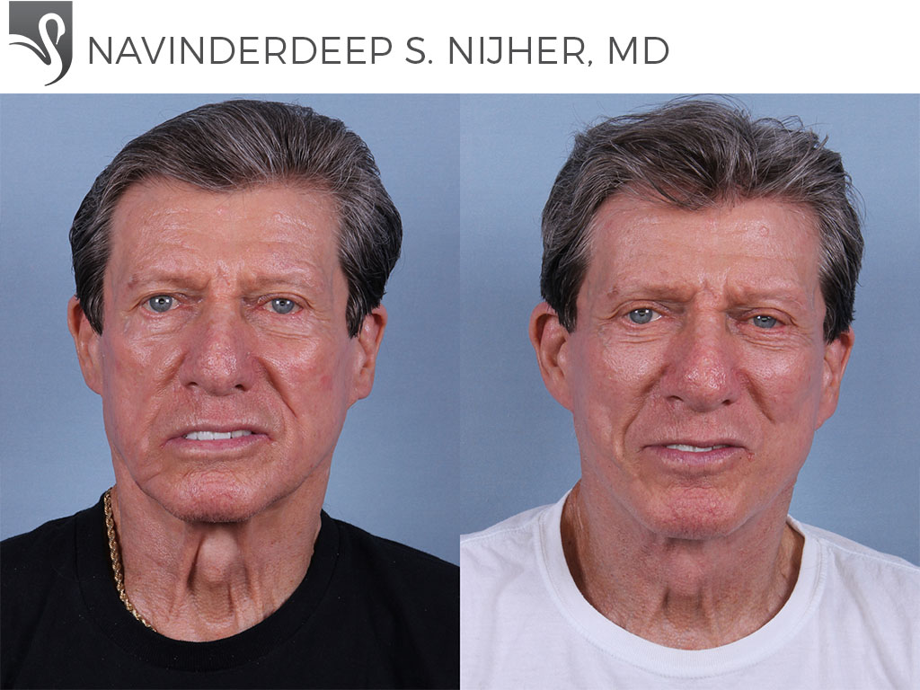 Before and After Image: Face Lift Case #74171 - front