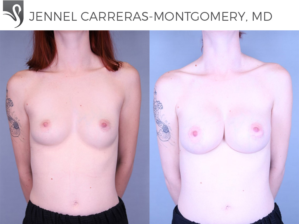 Before and After Image: Breast Augmentation Case #74260 - front