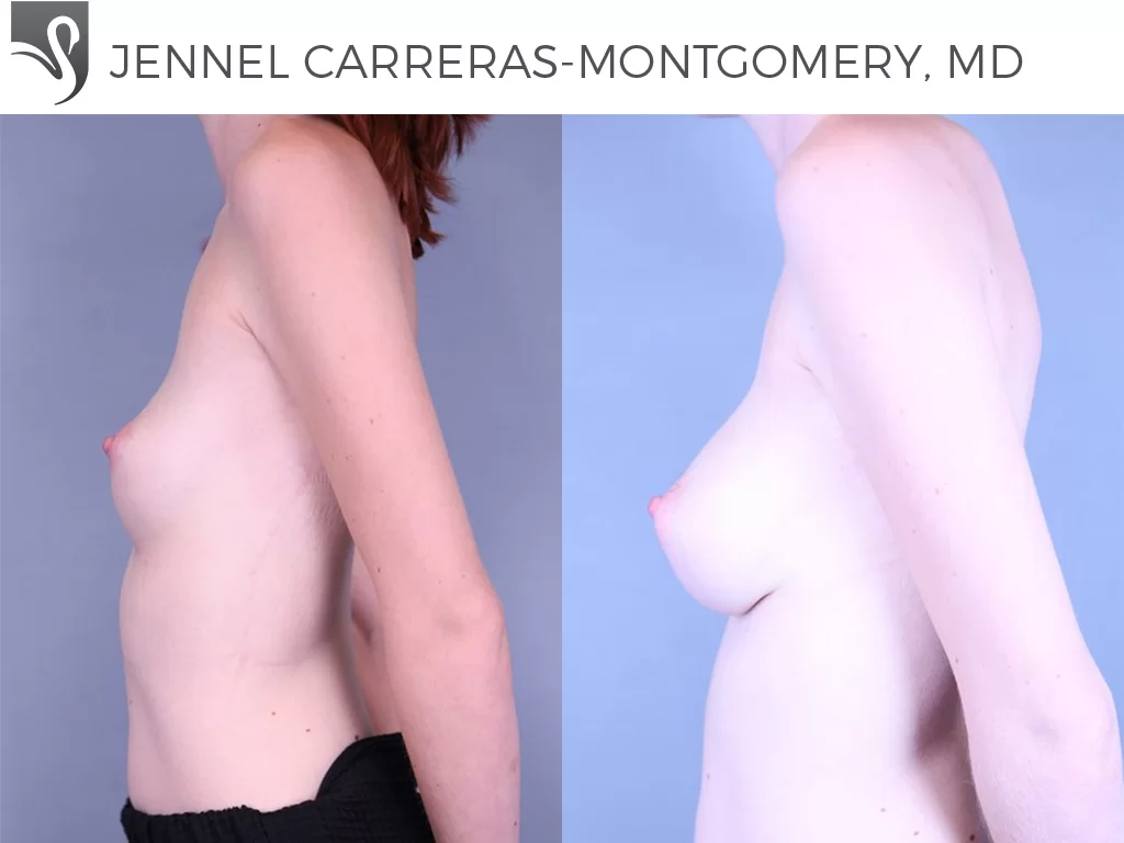 Before and After Image: Breast Augmentation Case #74260 - left-side