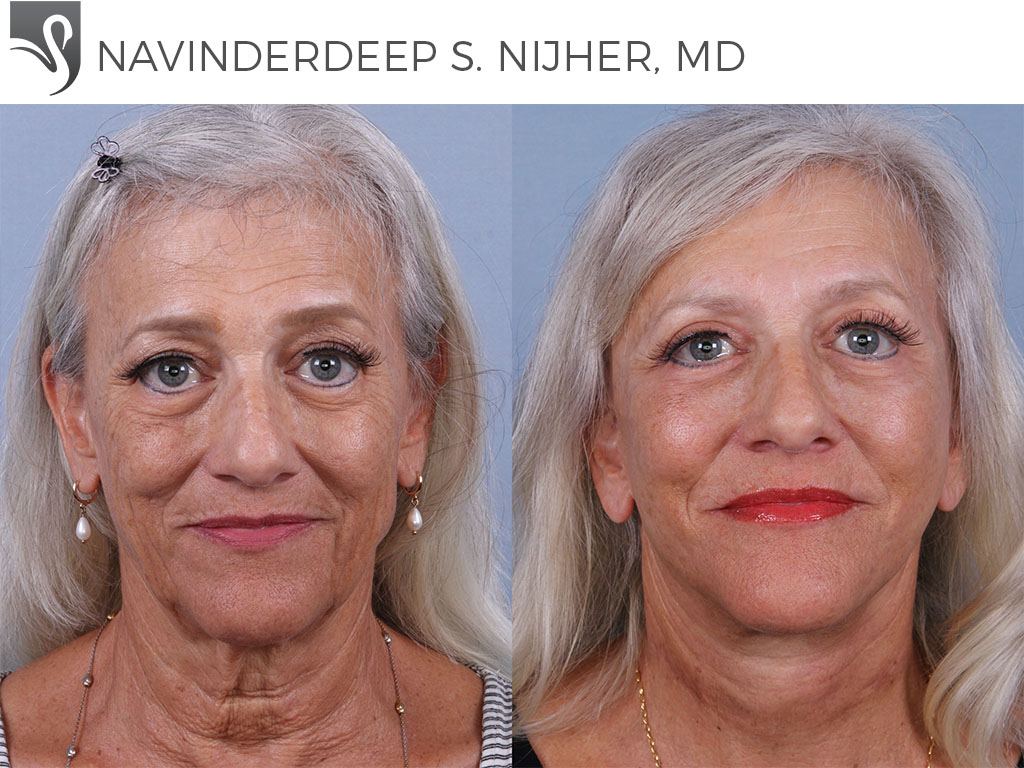Before and After Image: Face Lift Case #74261 - front
