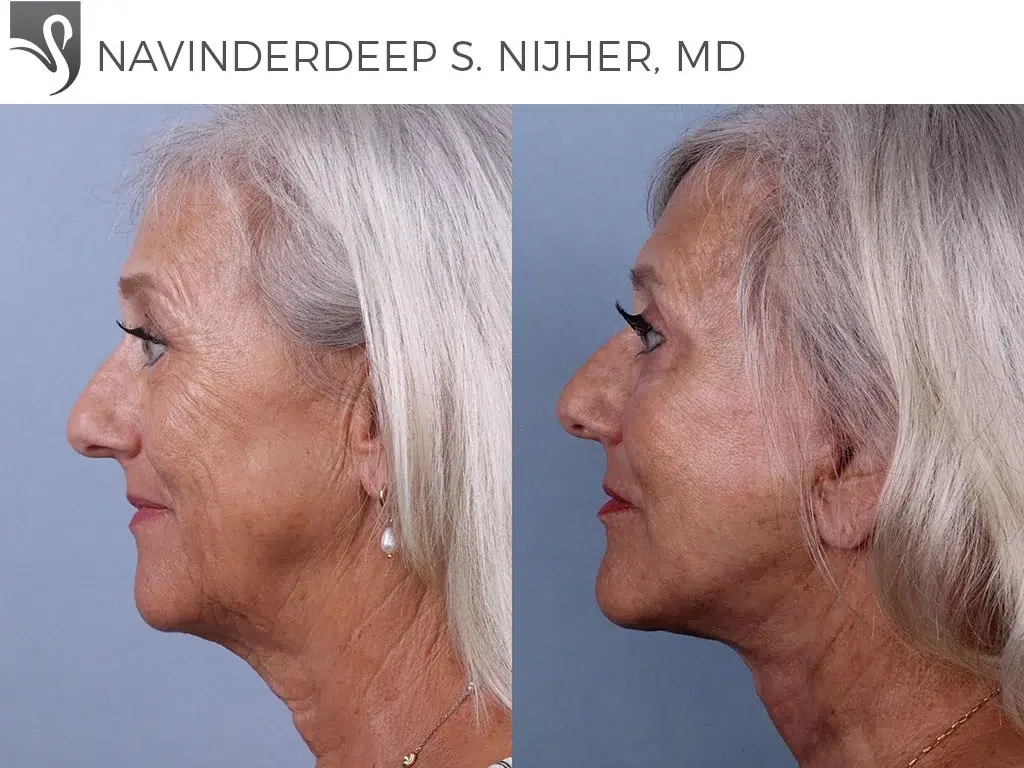 Before and After Image: Face Lift Case #74261 - left-side