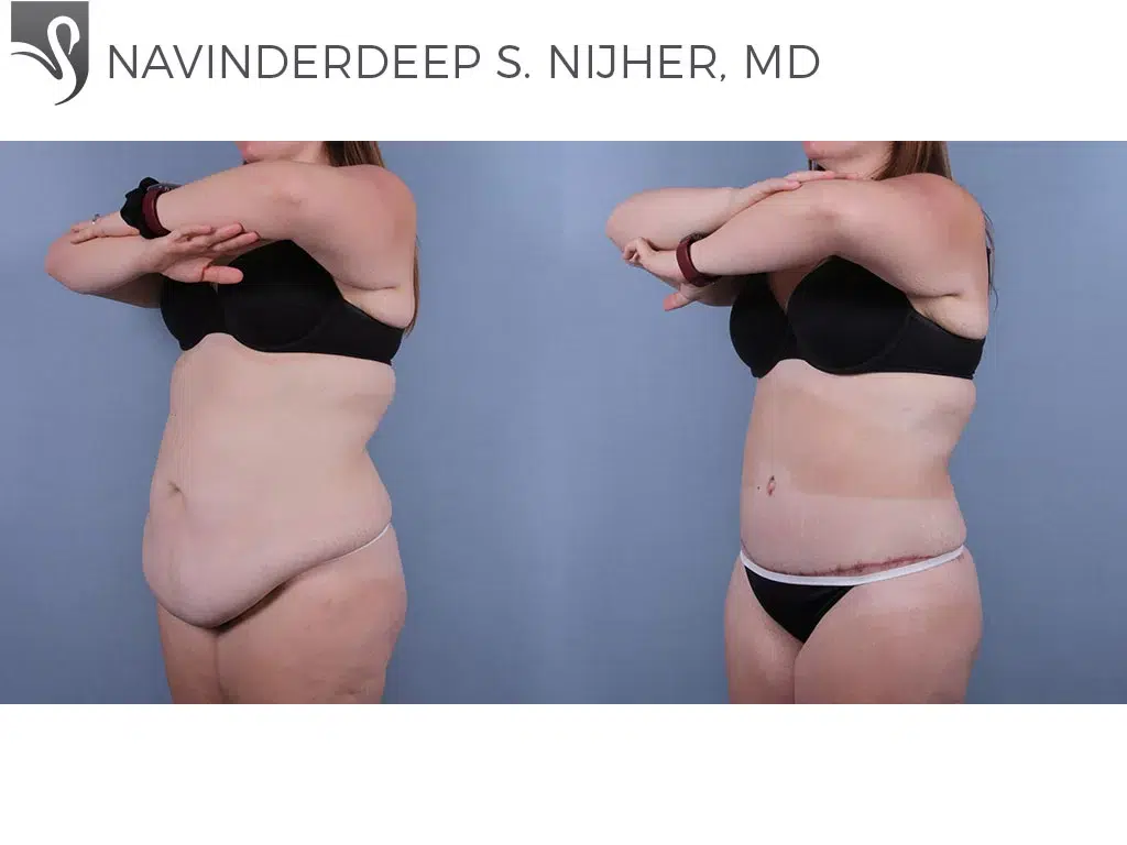 Before and After Image: Abdominoplasty (Tummy Tuck) Case #74331 - left-front-oblique