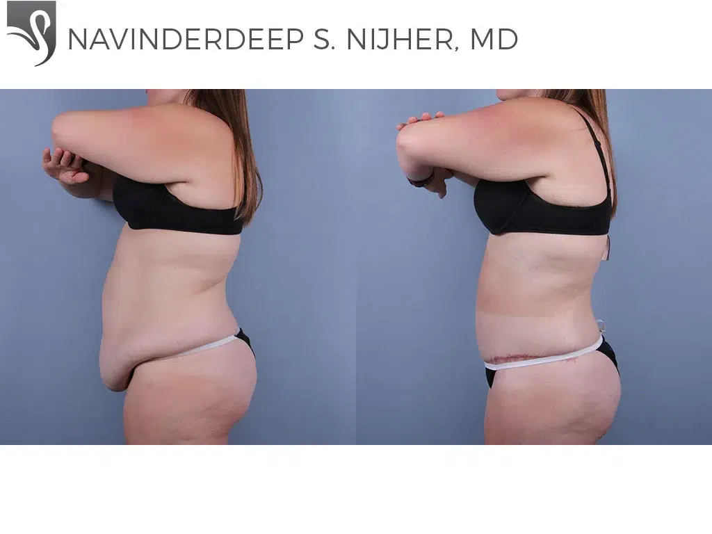 Before and After Image: Abdominoplasty (Tummy Tuck) Case #74331 - left-side