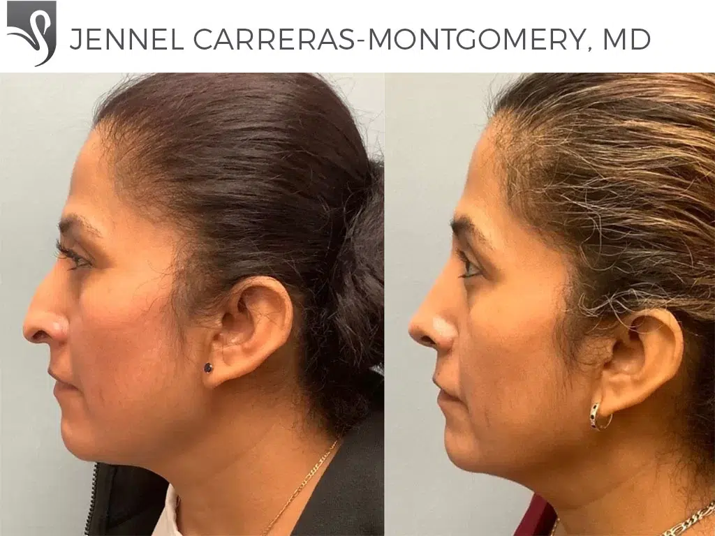 Before and After Image: Rhinoplasty Case #74390 - left-side