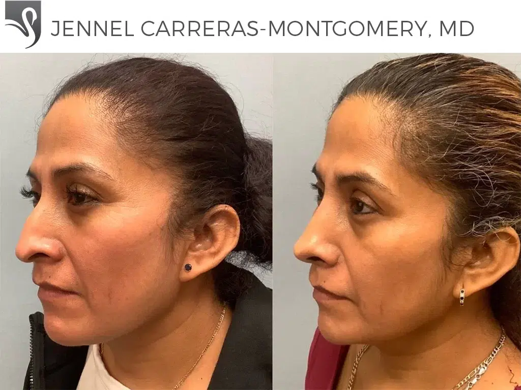 Before and After Image: Rhinoplasty Case #74390 - left-front-oblique