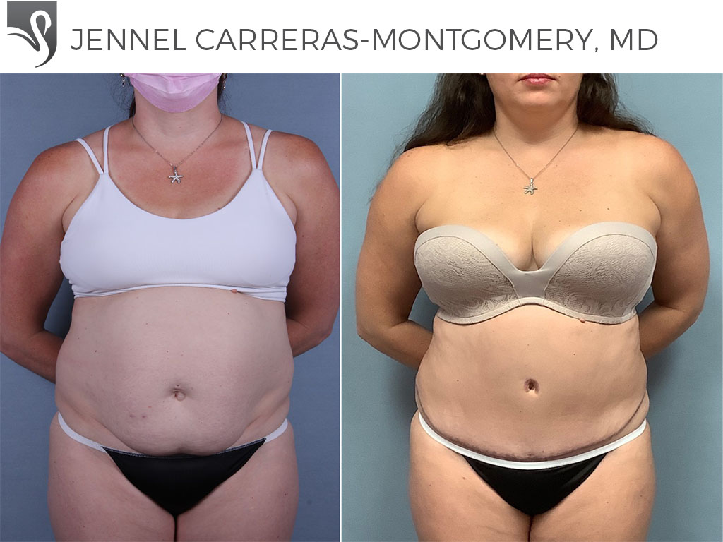 Before and After Image: Abdominoplasty (Tummy Tuck) Case #74509