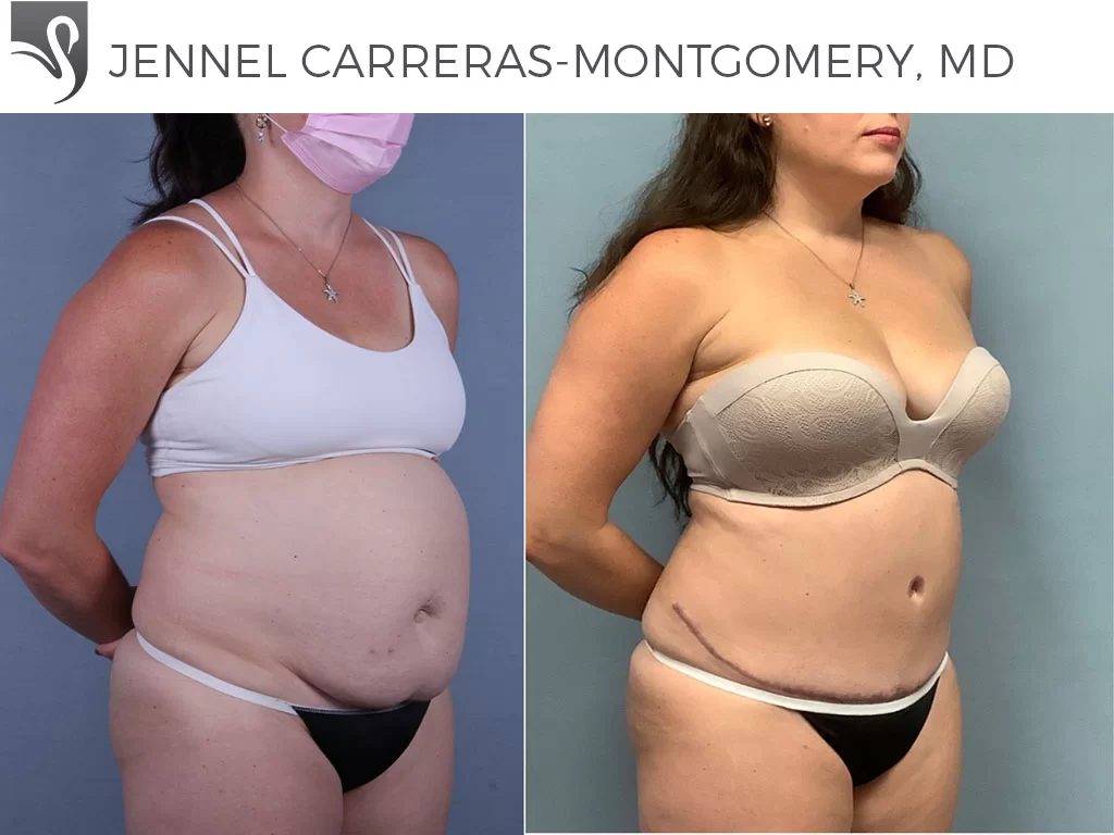 Before and After Image: Abdominoplasty (Tummy Tuck) Case #74509 - right-front-oblique