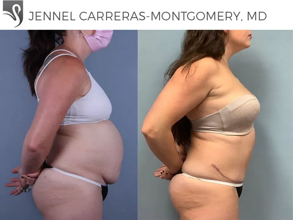 Before and After Image: Abdominoplasty (Tummy Tuck) Case #74509 - right-side