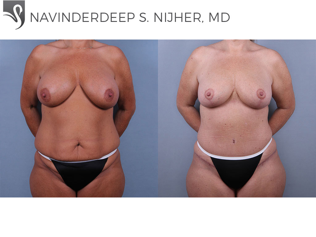 Before and After Image: Abdominoplasty (Tummy Tuck) Case #74532 - front